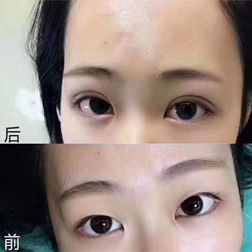无痕眼皮培训